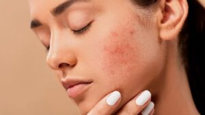 Natural Remedies for Fading Facial Scars